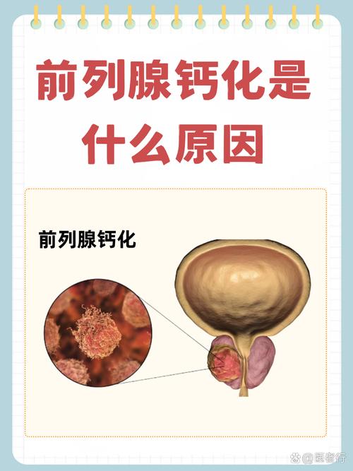 前列腺钙化是前列腺炎留下的疤吗