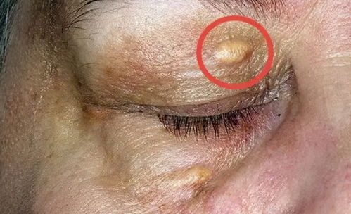 低密度脂蛋白高：被称为坏胆固醇的食物黑名单