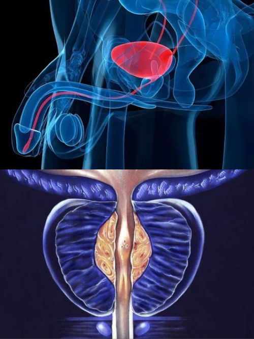 前列腺炎分急性和慢性怎么区分