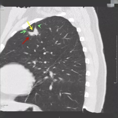 乳腺叶状肿瘤是良性还是恶性怎么治疗