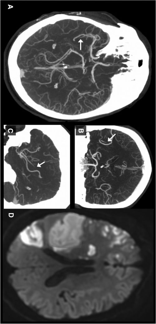 原发性和继发性区别