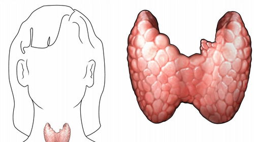 甲状腺髓样癌-甲状腺结节伴腹泻，降钙素明显升高