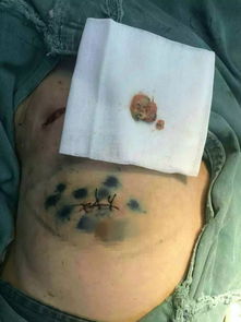 淋巴瘤-腋下淋巴结肿大消炎药吃了两周没消,普外科医生说别再吃了 淋巴瘤-腋下淋巴结肿大消炎药吃了两周没消,普外科医生说别再吃了