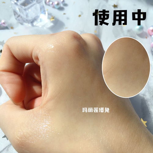 水肿-早上眼睑肿当肾虚治，肾内科查尿发现蛋白尿+++