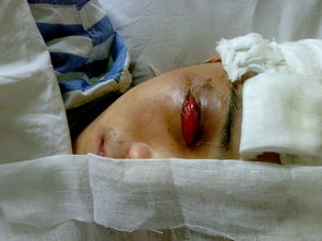 水肿-早上眼睑肿当肾虚治，肾内科查尿发现蛋白尿+++