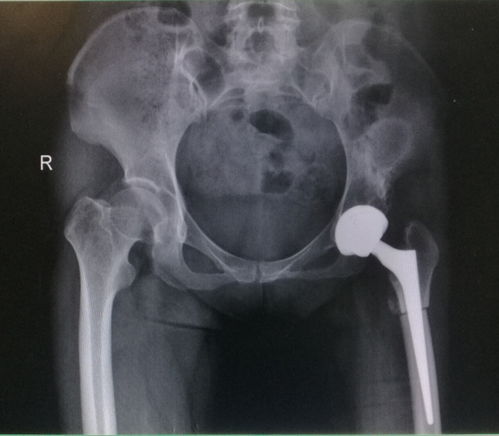 先天性髋关节脱位：髋关节不稳