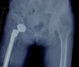 先天性髋关节脱位：髋关节不稳