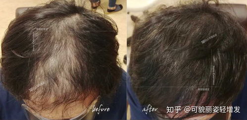 非那治疗脱发每天吃多少