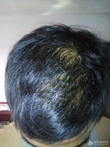 非那,治疗,脱发,每天,多少