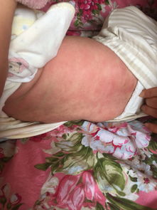 宝宝湿疹怎么护理