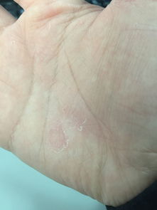 怎么判断自己湿气重