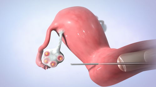 两个女的怎么做试管婴儿