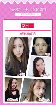 下巴整形手术方式：下巴整形与假体植入、玻尿酸填充