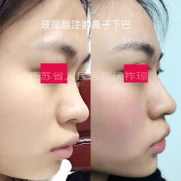 上海,整形,哪里,注射,美容