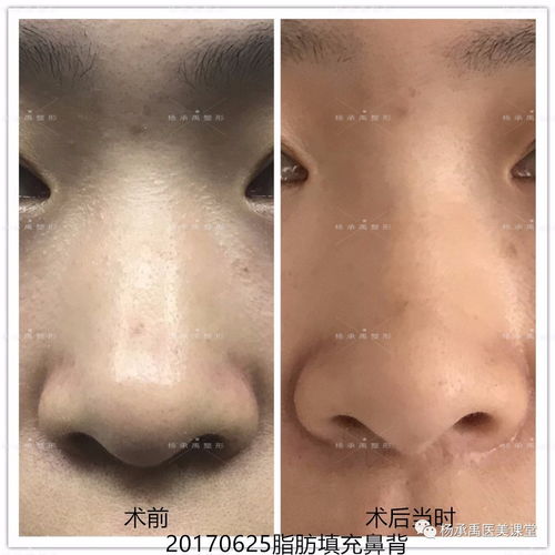 颌骨,整形,手术,风险,大吗