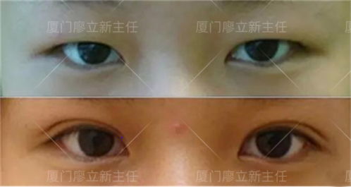双眼皮整形手术方式：双眼皮整形与埋线、全切、微创选择