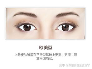 双眼皮,整形,手术,方式,埋线