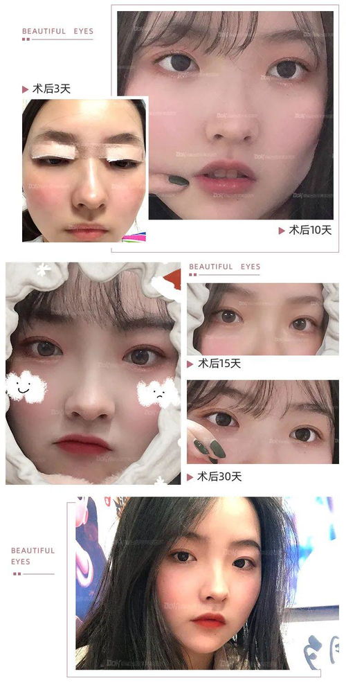 双眼皮整形美容医院怎么选？双眼皮整形美容医院与眼部修复专家