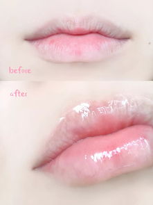 嘴巴整形手术方式：嘴巴整形与唇部、口周年轻化手术