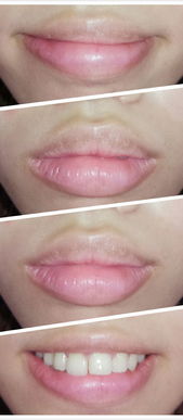 嘴巴整形手术方式：嘴巴整形与唇部、口周年轻化手术