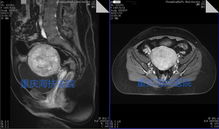 横纹,肉瘤,儿童,颈部,肿块