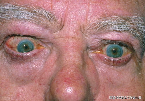 横纹肌肉瘤-儿童头颈部肿块，病理腺泡型