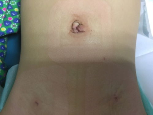 横纹肌肉瘤-儿童头颈部肿块，病理腺泡型