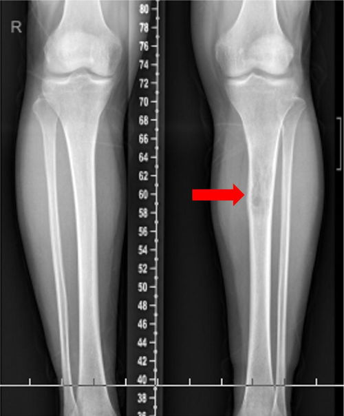 淋巴结肿大-颈部淋巴结肿大切除后病理提示结核，不是肿瘤但也要治