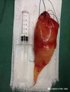 淋巴结肿大-颈部淋巴结肿大切除后病理提示结核，不是肿瘤但也要治