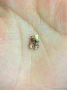 克罗恩病：从口到肛都可能发炎，肠壁增厚狭窄