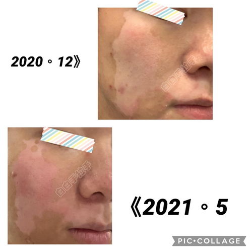 光动力治疗：涂药照光，防复发