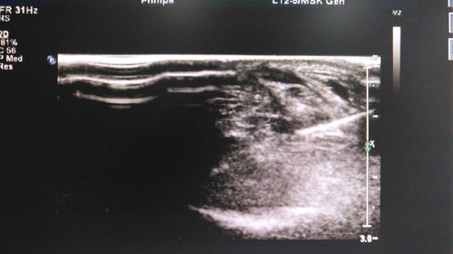 关节超声：看关节滑膜炎，比X光早