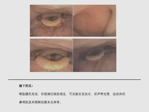 慢性,咽炎,反复,发作,怎么