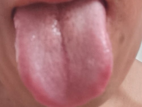 慢性咽炎反复发作，怎么调理才能断根