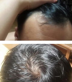 掉头发是什么原因