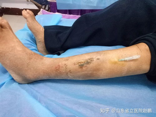 男科病久治不愈怎么办