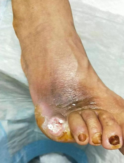 中药熏洗治痔疮，坐浴泡脚熏蒸疗法大全