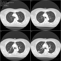 尿痛-尿痛当尿路感染治了半年，妇科医生发现是间质性膀胱炎