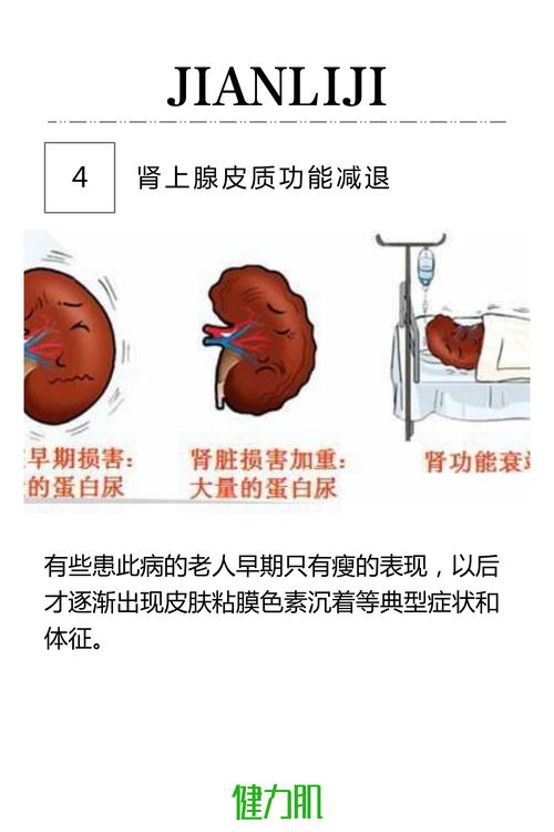冠心病,是什么,早期,症状,防治