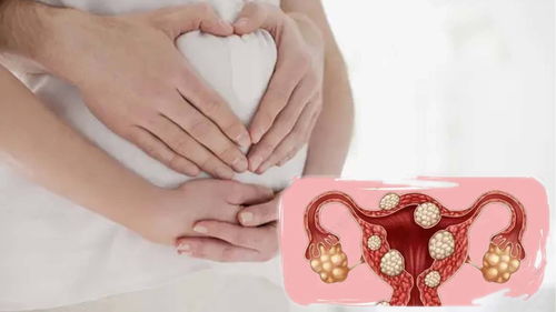 桂枝茯苓丸能消肌瘤吗