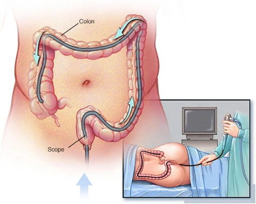 罗恩,饮食,发作,和缓,解期