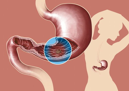 罗恩,病的,这些,食物,诱发