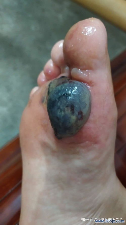 冷冻治疗：冻掉疣体