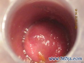 肛裂排便像刀割，怎么愈合