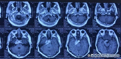 肝囊肿需要治疗吗？多大要处理