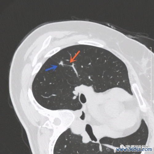肺结节越来越多见，什么情况要手术