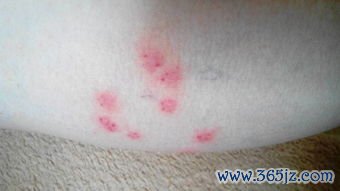 红斑不痛不痒是什么东西 红斑不痛不痒是什么东西