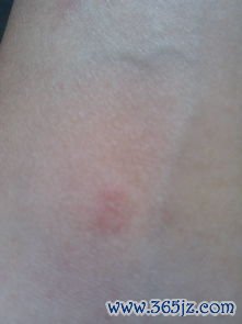 红斑,不痛不痒,是什么,东西