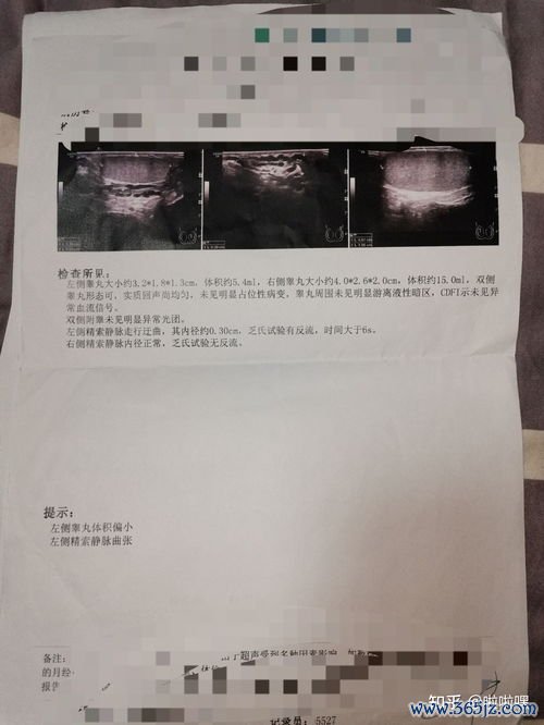 精索,静脉曲张,影响,生育