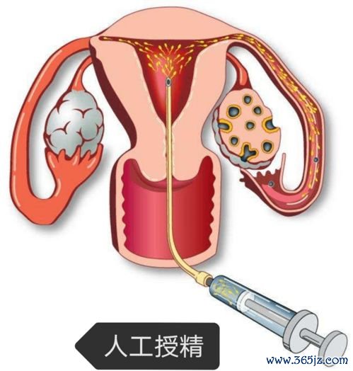 人工授精和试管哪个好怎么选择
